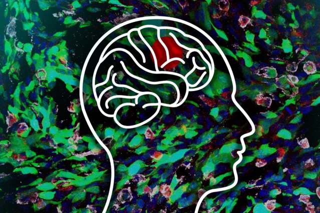 OncologyNation's tweet photo. Biologists identify possible new strategy for halting brain tumors 
https://t.co/Eid35Dfw1j #cancer #braincancer @medialab https://t.co/svFjKsXwOT