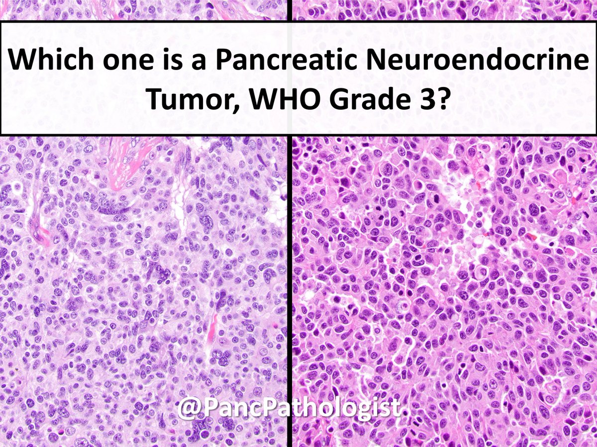PancPathologist's tweet photo. The distinction between G3 #PancreaticNeuroendocrine Tumors &amp; Carcinomas can be challenging. Can you tell the difference? #GIPath #Pathology https://t.co/Vx6AYJQyWy
