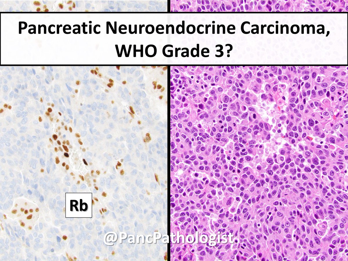 PancPathologist's tweet photo. The distinction between G3 #PancreaticNeuroendocrine Tumors &amp; Carcinomas can be challenging. Can you tell the difference? #GIPath #Pathology https://t.co/Vx6AYJQyWy