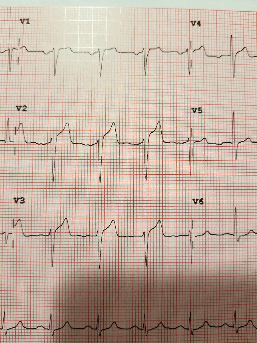 nurse_face's tweet image. *Hands EKG to doc*  his response.."oh that might be real" um you think?! 😲 Didn't know you could fake a STEMI #ERNurse #EKG #pleasedontcode