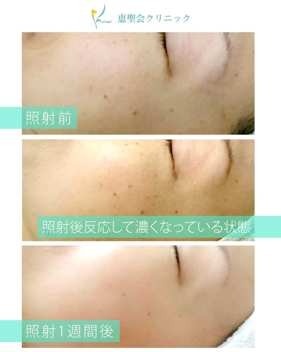 恵聖会クリニック 夏疲れ肌をリセット フォトフェイシャルm22 出来てしまったシミ そばかすを解消し肌にハリがでてキメが細かくなります 詳細はこちら T Co Tpduobgbp1 恵聖会 フォトフェイシャル M22 シミ そばかす 美肌になりたい