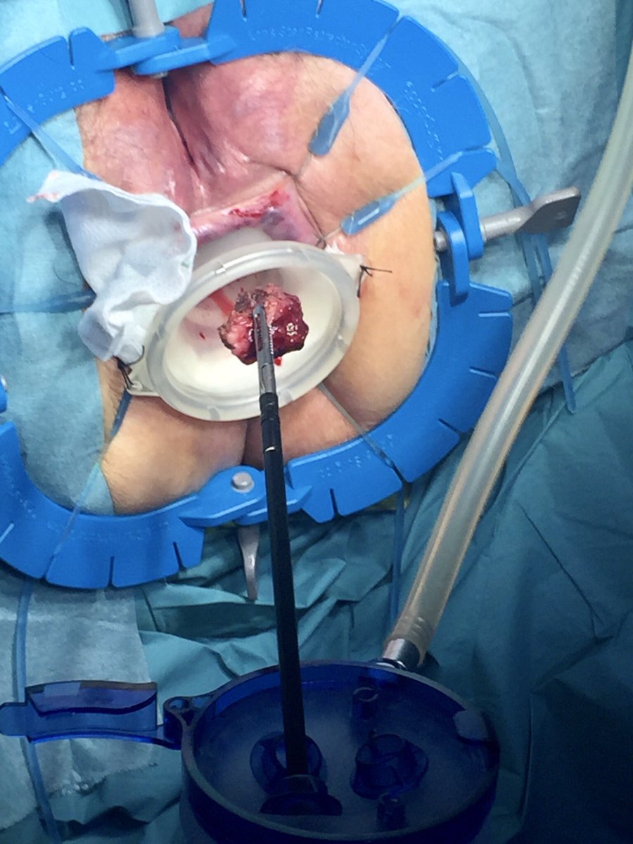 Gabboddg's tweet photo. Performing TAMIS resection in a rectal polyp @althaiamanresa with @ColleraPablo we enjoy #minimalinvasive & #transanalapproach https://t.co/uFgMBm3Ghj