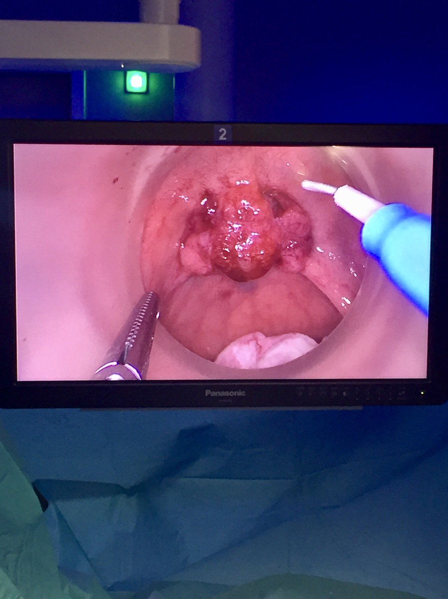 Gabboddg's tweet photo. Performing TAMIS resection in a rectal polyp @althaiamanresa with @ColleraPablo we enjoy #minimalinvasive & #transanalapproach https://t.co/uFgMBm3Ghj