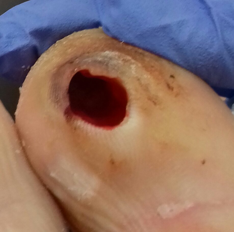 manuel_belver's tweet photo. @spingles5 This is my toe after stepping on a jara while running across the field in Samir de los Caños https://t.co/xsjFAjE23y
