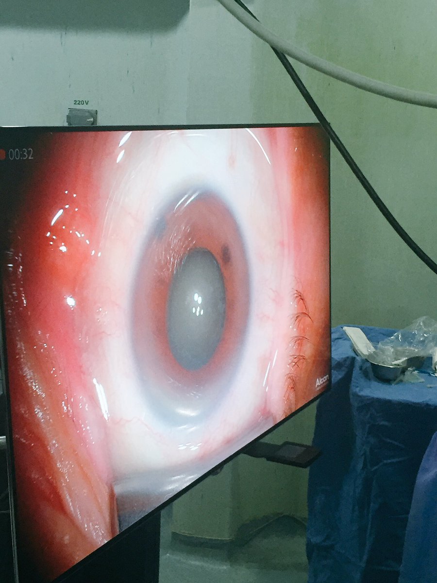 dr_robertogs's tweet photo. NGENUITY® 3D Visualization System #3Dcataractsurgery #cataractsurgery #IOLsurgery #phacoemulsification #ophthalmology https://t.co/L4mDA8nnzV