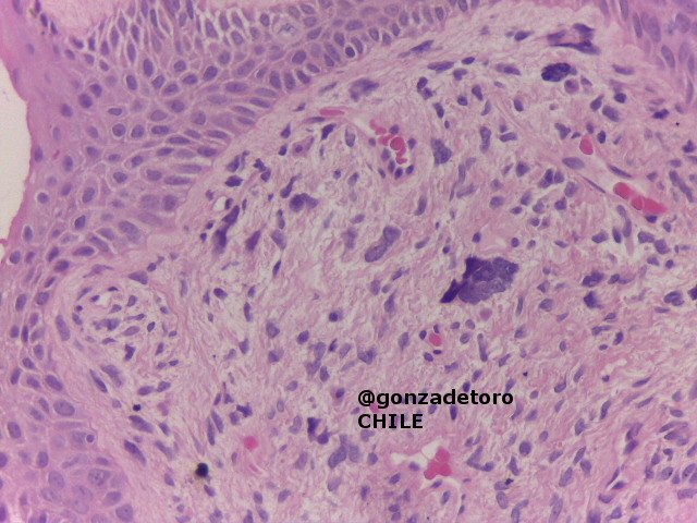Gonzalo De Toro (@gonzadetoro) on Twitter photo <a href="/EHFultonMD/">Edward Fulton, MD</a> <a href="/JMGardnerMD/">Jerad Gardner, MD</a> <a href="/MSLDermatopato/">MSLDERMATOPATO</a> <a href="/Dermatopatol/">Maite Fdez Figueras</a> <a href="/Dermpathl/">Dermpath-L</a> <a href="/DoruAndea/">Aleodor Andea</a> <a href="/vgprieto14/">Dr. Victor Prieto</a> High power onychomatricoma 😜 #dermpath #dermatology #dermatopathology <a href="/EHFultonMD/">Edward Fulton, MD</a> <a href="/JMGardnerMD/">Jerad Gardner, MD</a> <a href="/MSLDermatopato/">MSLDERMATOPATO</a> <a href="/Dermatopatol/">Maite Fdez Figueras</a> <a href="/Dermpathl/">Dermpath-L</a> <a href="/DoruAndea/">Aleodor Andea</a> <a href="/vgprieto14/">Dr. Victor Prieto</a> High power onychomatricoma 😜 #dermpath #dermatology #dermatopathology