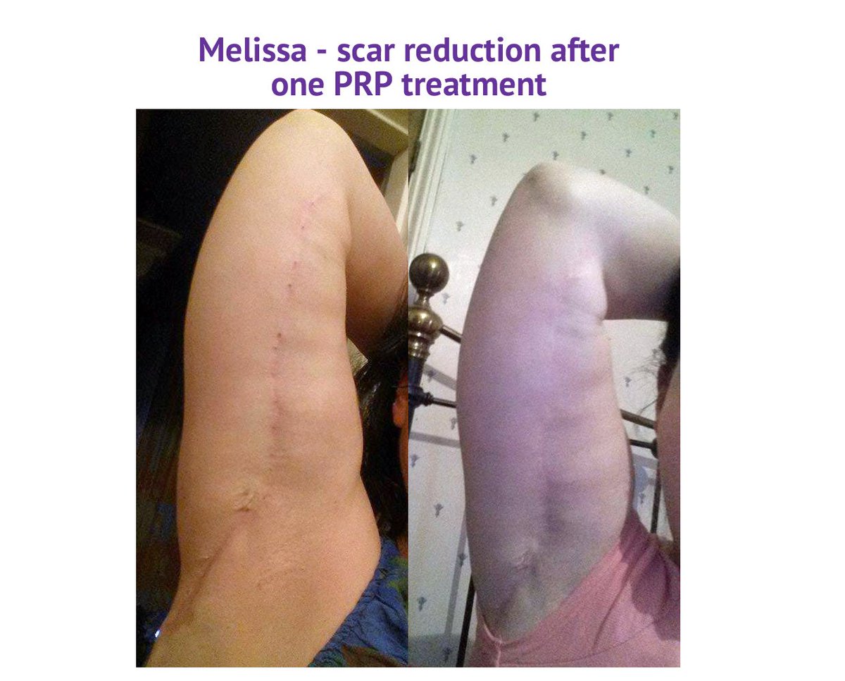 We love this image of <a href="/ForemanFactor/">Mel Austin Foreman</a> before and after #prp #draculatherapy for her scars on arms following #weightlosssurgery #results