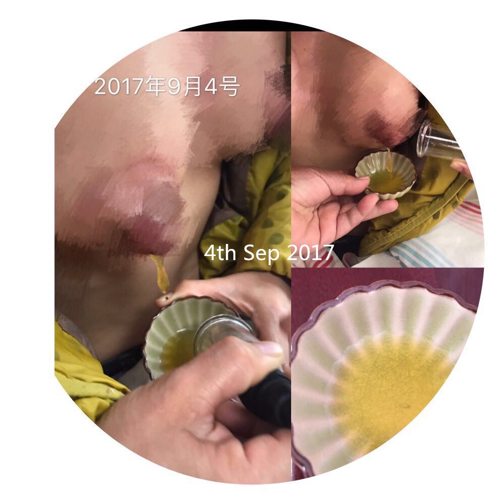 AfricanBiboting's tweet photo. How we saves one woman , and preventing her getting breast cancer. Attached photo shows the whole process , help her pull lump out of breast.
1.in early sep, it is yellow liquid , come out2.in later stage, it it red color;3.the blood liquid soon become LUMP again when cold out https://t.co/q076E21DiM