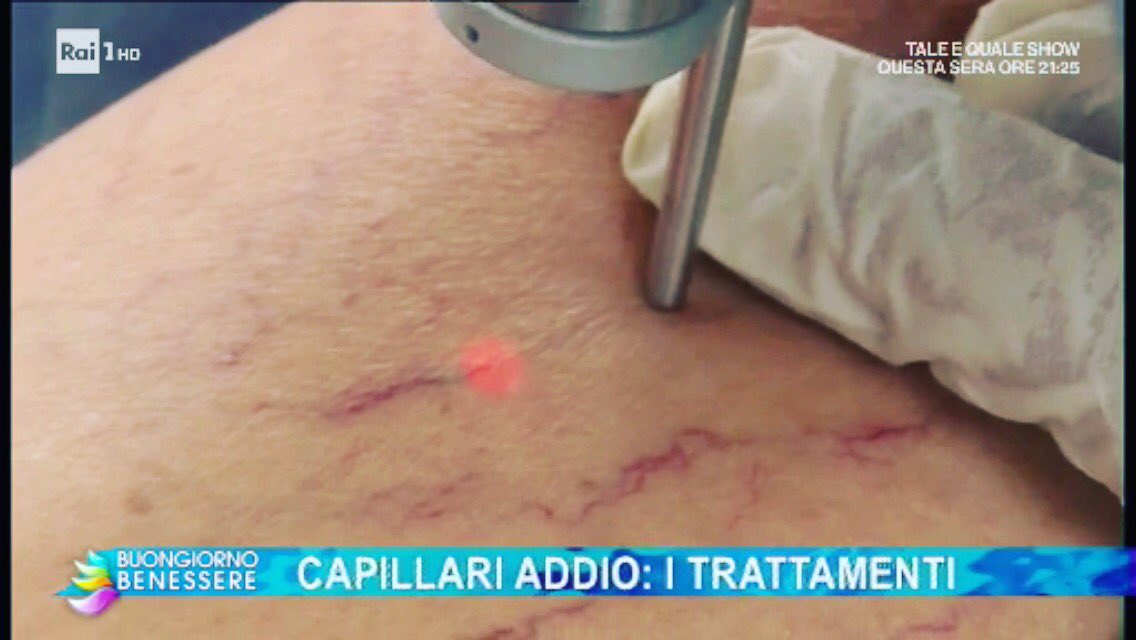 nisticoderm's tweet photo. Consigli su trattamento di teleangectasie e capillari degli arti inferiori con Laserterapia, dal minuto 29 su: https://t.co/dpqPzNTy8a https://t.co/ggayvGlIpb