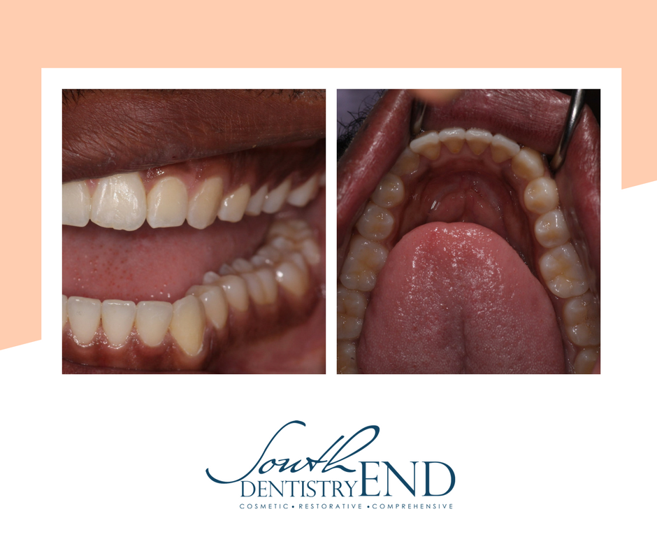 Alan just finished his Invisalign treatment and his teeth are looking so straight! Find out what Invisalign can do for your smile!!😄