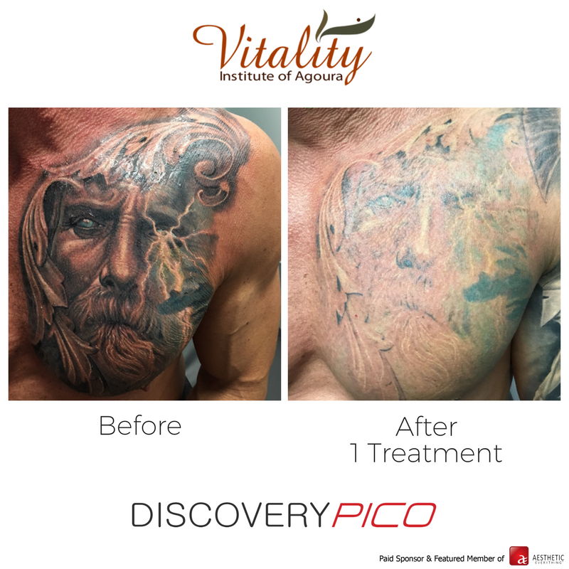 AestheticEvExpo's tweet photo. Discovery PICO from @QuantaLaser is the most powerful picosecond laser on the market https://t.co/Aq9MRz3McI #DiscoveryPICO #plasticsurgery https://t.co/xtQkPrhGng