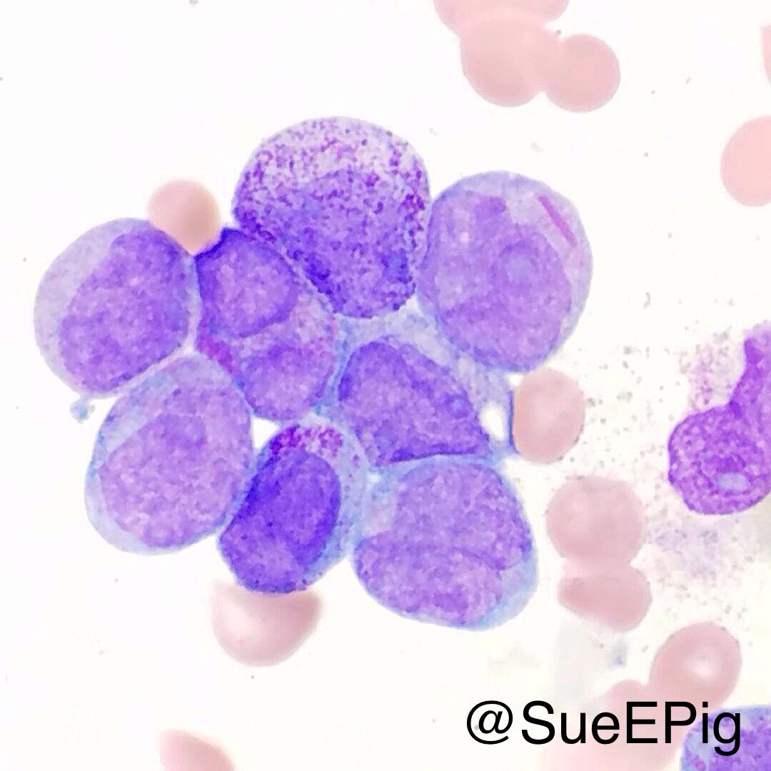 SueEPig's tweet photo. Can you spot the auer rod? #auerrods #pathognmonic #translocation1517 #APML #ATRA #hemepath #hhpath https://t.co/7jdi4nxNAJ