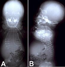 RcknRibosomes's tweet photo. Golgi causes Achondrogenesis-group of severe disorders that affect cartilage and bone development @QUEENgolgi @allshookupbybio https://t.co/BdS2meytCP