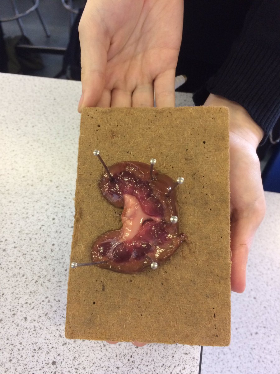 WingfieldSci's tweet photo. Urine for a treat! Well done y11 triple.#kidneydissection https://t.co/Tww6EB08fx