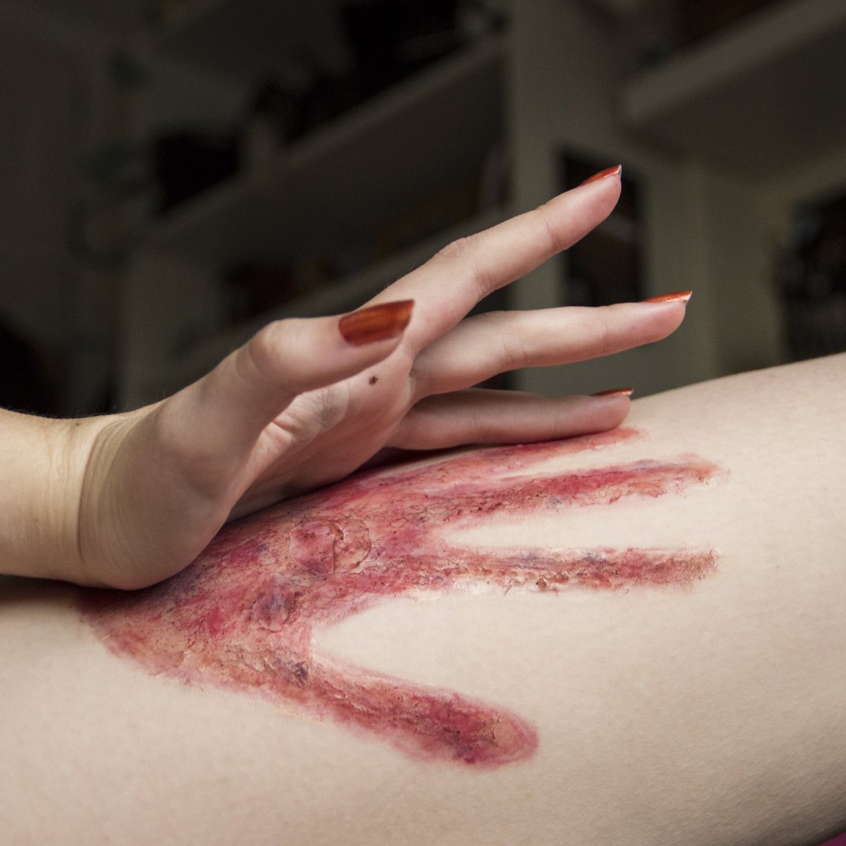 crybabybleu's tweet photo. #31daysofhalloween day 12 🖖🏻 handprint burn https://t.co/iwBtWpahQn