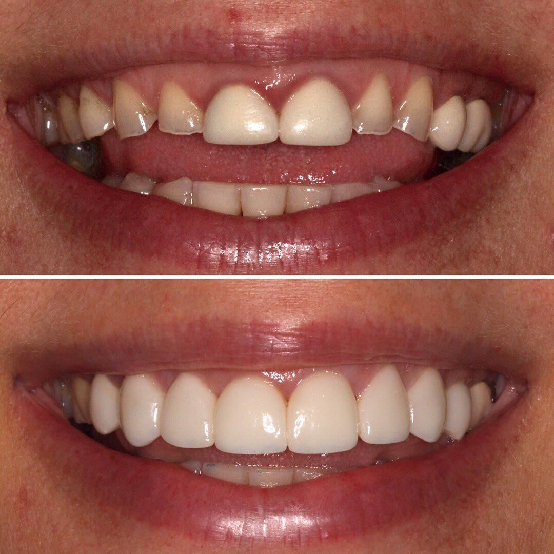 drandrewjkeller's tweet photo. Veneers by Dr. Andrew Keller. #smilemakeover #veneers #bellevuedentist #lovemyjob #davincidental https://t.co/PdhvaPk8rR