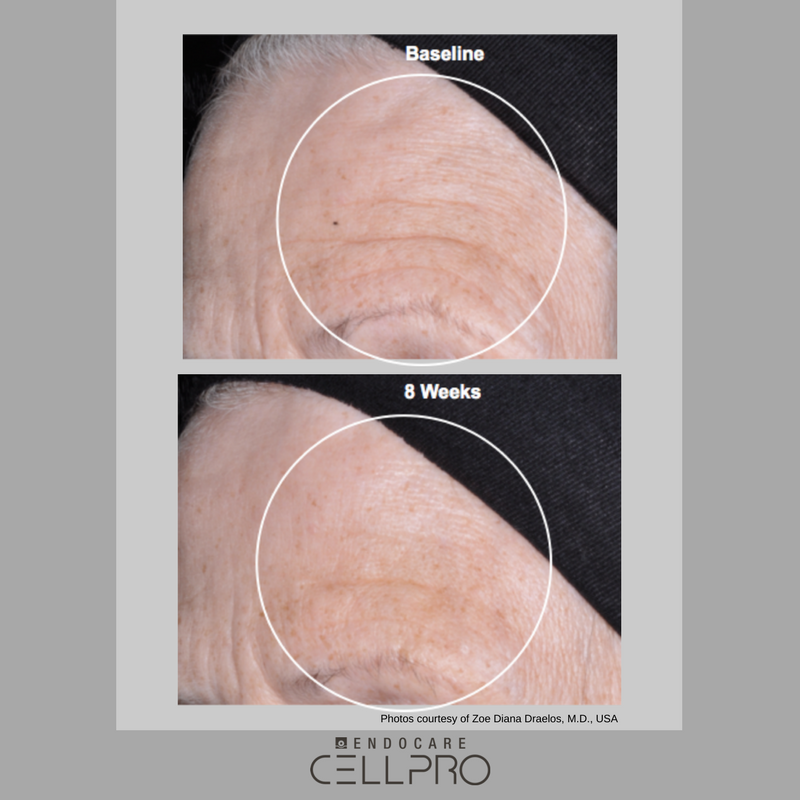 AesthetiCareUK's tweet photo. ๐ R e a l R e s u l t s ๐ after application twice daily for 8 weeks
#wakeywakey #endocarecellpro #skinrejuvenation https://t.co/k8qGf0emLu