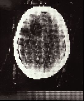 ARRS_Radiology's tweet photo. 45 yrs ago today, the CT scanning developed by Godfrey Hounsfield was introduced w/ the 1st successful scan on a cerebral cyst patient. https://t.co/8WUjRXk5lK