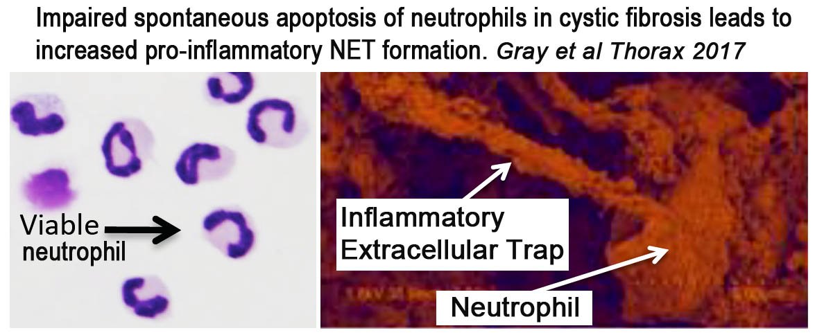 Our paper: #neutrophil death &amp; #inflammation in #cysticfibrosis R.Gray <a href="/The_MRC/">Medical Research Council</a> <a href="/wellcometrust/">Wellcome</a> <a href="/cftrust/">Cystic Fibrosis Trust</a> <a href="/britsocimm/">British Society for Immunology</a> 
ncbi.nlm.nih.gov/pubmed/2891670…