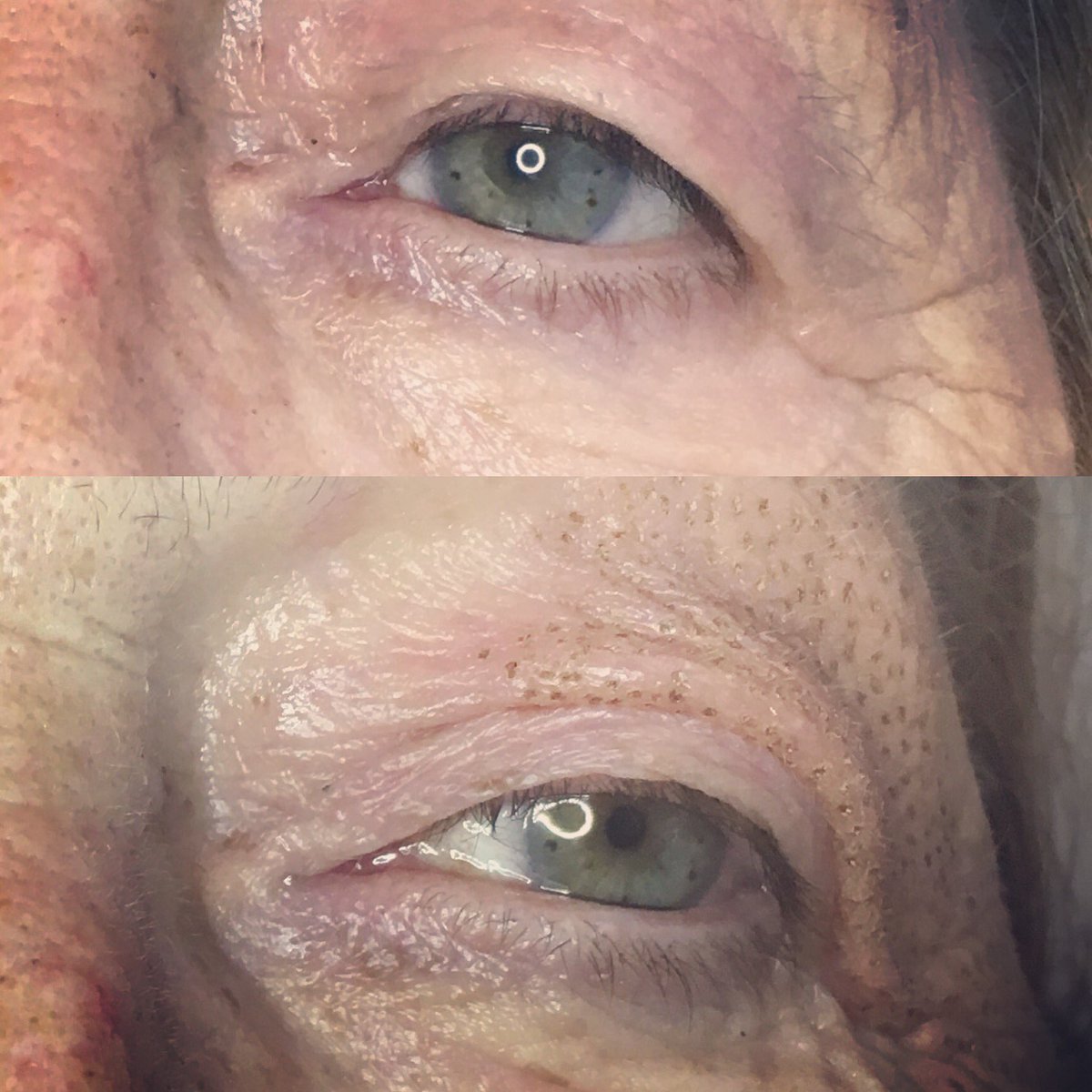 This clients hooded lids pushed down on her lash line. Look what a difference this amazing treatment can make!