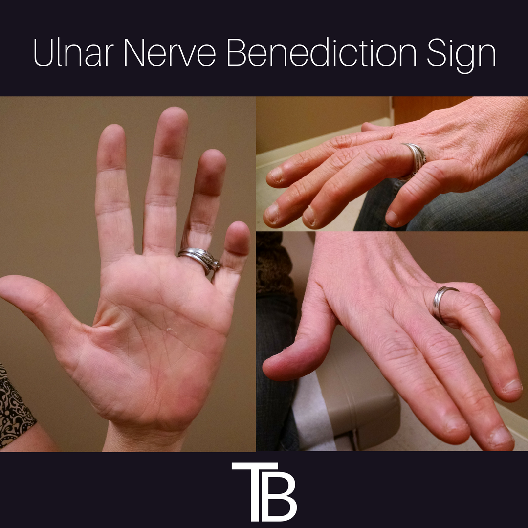 Hand Of Benediction Deformity