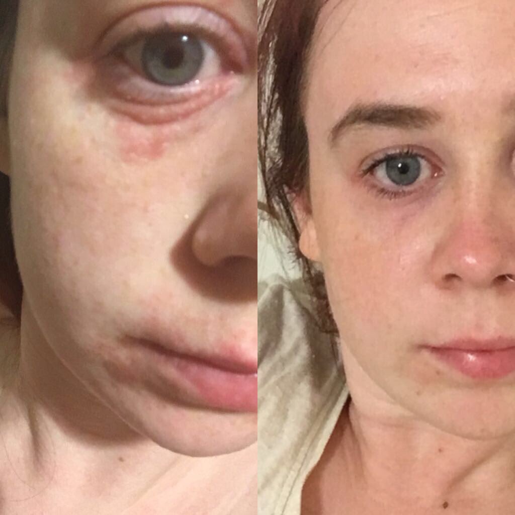 SkinRepair6's tweet photo. I offer treatments to improve the condition of your skin using the most suitable products to help, with some amazing results #bedshour #skincare #skincareroutine #skinrepair https://t.co/XadIOBOeMr