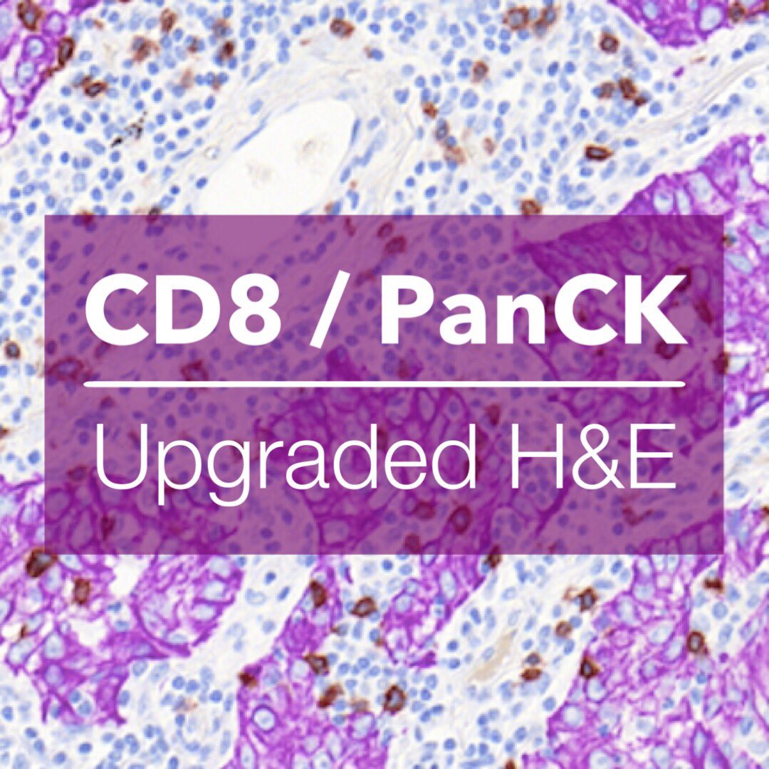 HistoGeneX's tweet photo. Introducing our PanCK-CD8 assay: a validated, fully-automated IHC double stain assay that demarcates the position of CD8-expressing T cells. https://t.co/PvRkNQXpLB