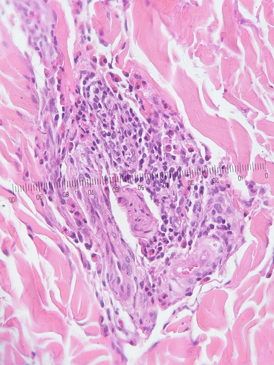 A nice case of Eosinophilic Annular Erythema #dermpath