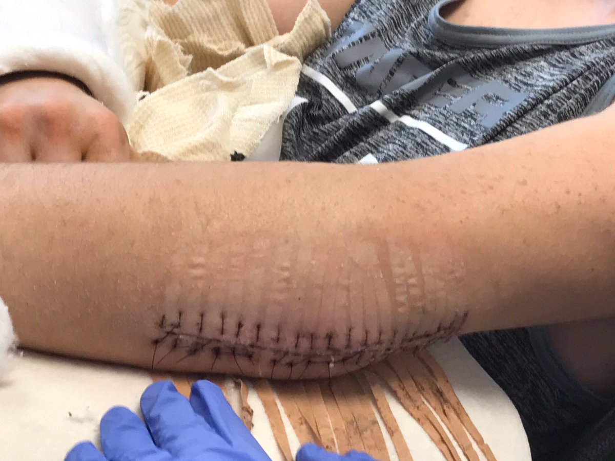 Stritzyy's tweet image. youtu.be/HslqzmBXWn4 recovery from 2 shattered elbows and broke femur @Gymshark @bpi_sports @Team_Optimum @BSNSupplements @TeamGaspari