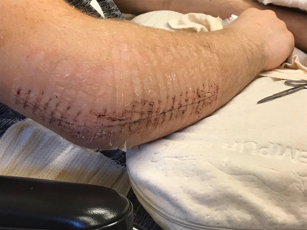 Stritzyy's tweet image. youtu.be/HslqzmBXWn4 recovery from 2 shattered elbows and broke femur @Gymshark @bpi_sports @Team_Optimum @BSNSupplements @TeamGaspari