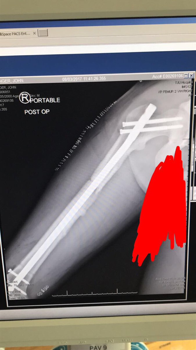 Stritzyy's tweet image. youtu.be/HslqzmBXWn4 recovery from 2 shattered elbows and broke femur @Gymshark @bpi_sports @Team_Optimum @BSNSupplements @TeamGaspari
