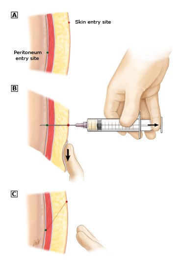 gpapo's tweet photo. Z-track technique for paracentesis lowers the chance of ascitic fluid leakage by creating non-linear pathway between fluid and skin #cincyai https://t.co/M6Dd1ryiul