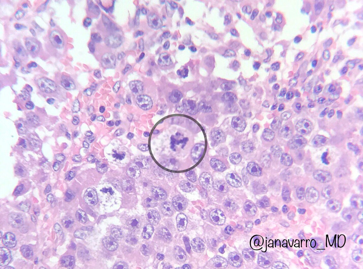 janavarro_MD's tweet photo. "M" stands for Multiple Mitoses on Monday!!! 😉 #pathpun #PathArt #Pathology @IHeartHisto @JMGardnerMD https://t.co/t3IZPUgCry