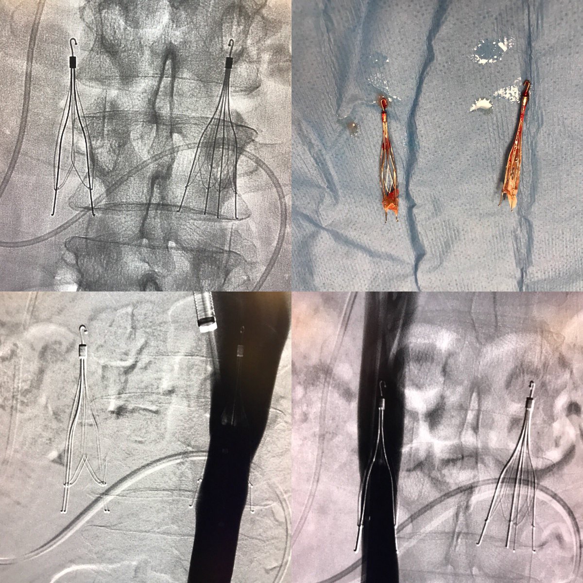 kush_r_desai's tweet photo. Duplicated IVC with 2x IVCF = Double the fun with 2x #filterOUT @NorthwesternIR @JVIRmedia @SIRspecialists  @SIRRFS https://t.co/28PNxZcRP8