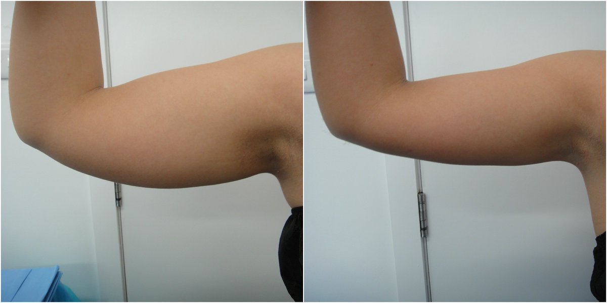 privateclinic's tweet photo. Wave goodbye to 'bingo wings' with MicroLipo #TPCTLC https://t.co/4zvbIOr9Oh