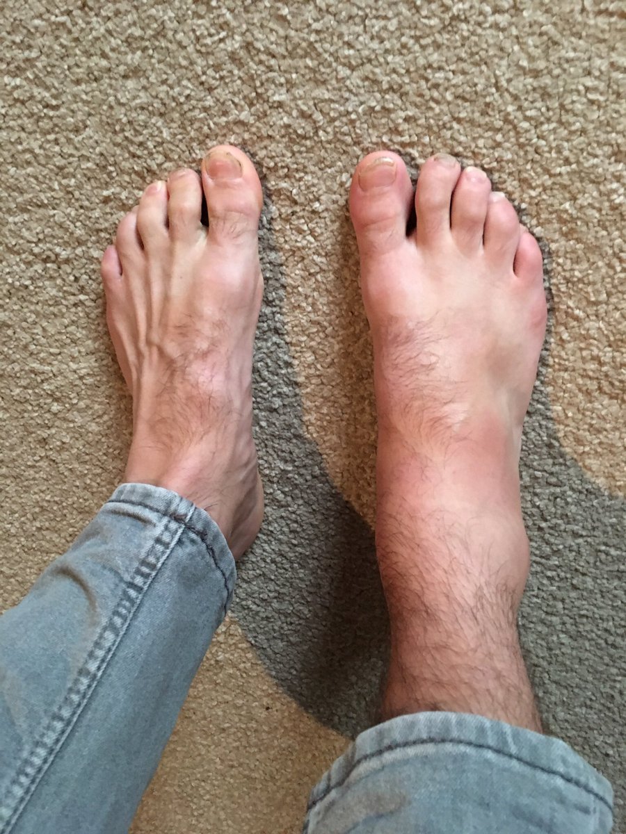 WalkWildUK's tweet photo. Stage 10 of @WalkWildUK #Challenge in #TheLakeDistrict ✅ incredible weekend but #Brokenbones #GetOutside @lakedistrictnpa @DevonAirAmb https://t.co/4udCbPbGoZ