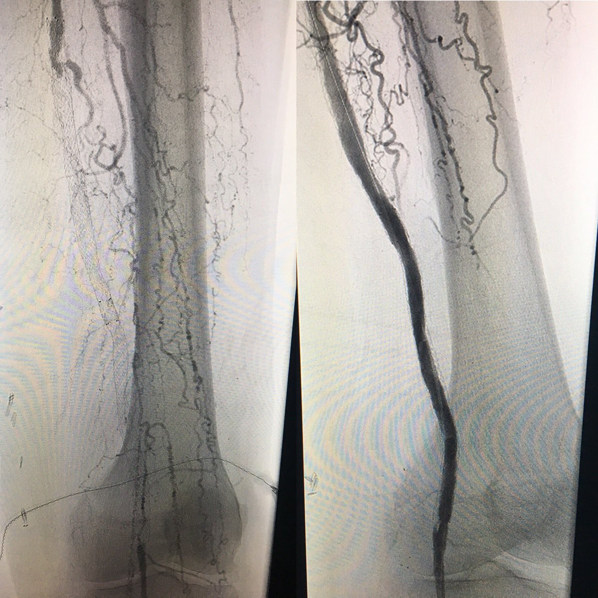 DanHan's tweet photo. #PADAwareness- Chronic long segment occlusion of SFA stent. I like to debulk w/ @bostonsci #jetstream then DCB. https://t.co/nVWfqqZAUk