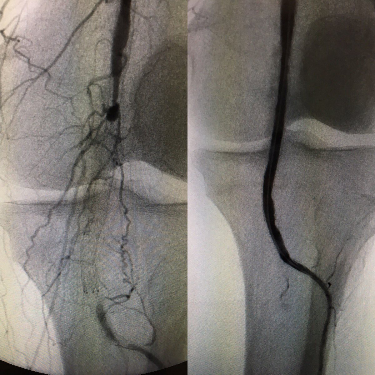 DanHan's tweet photo. #PADAwareness- Leave no metal behind if possible and avoid behind the knee.  Was able to get this open... but for how long? #jetstream + DCB https://t.co/8y5RoYMKwO