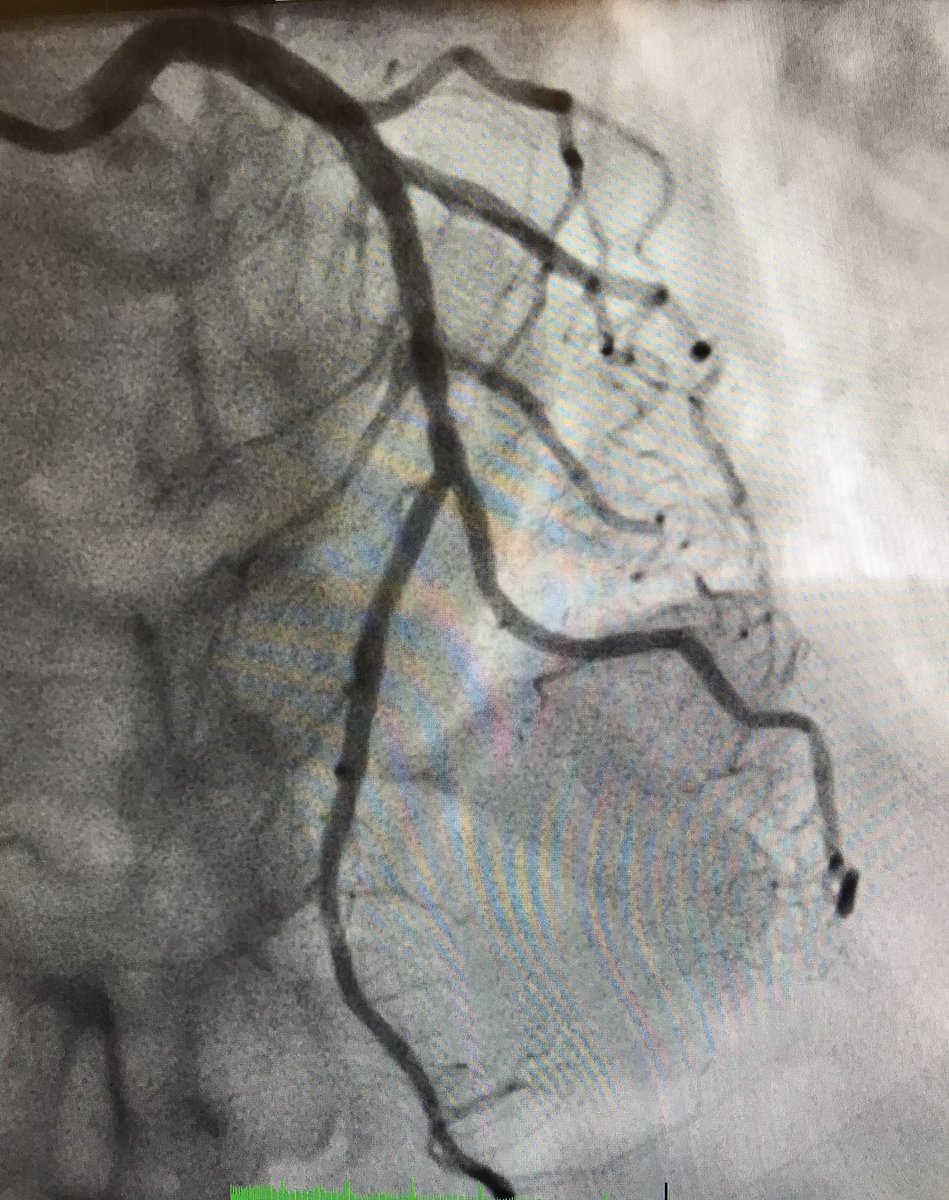 Rahul2282Sharma's tweet photo. 86F, "+Nuc stress", had weak B/L rad pulses. U/S'd both rad's->small (~1mm). Ulnars big, so went U/S-guided right #UlnarSecond. No sign of UAO on f/u. @mmamas1973 @Radial_ICG @SVRaoMD @willsuh76 @chadialraies @DrSheilaSahni @Pooh_Velagapudi https://t.co/6hnaLIiifV