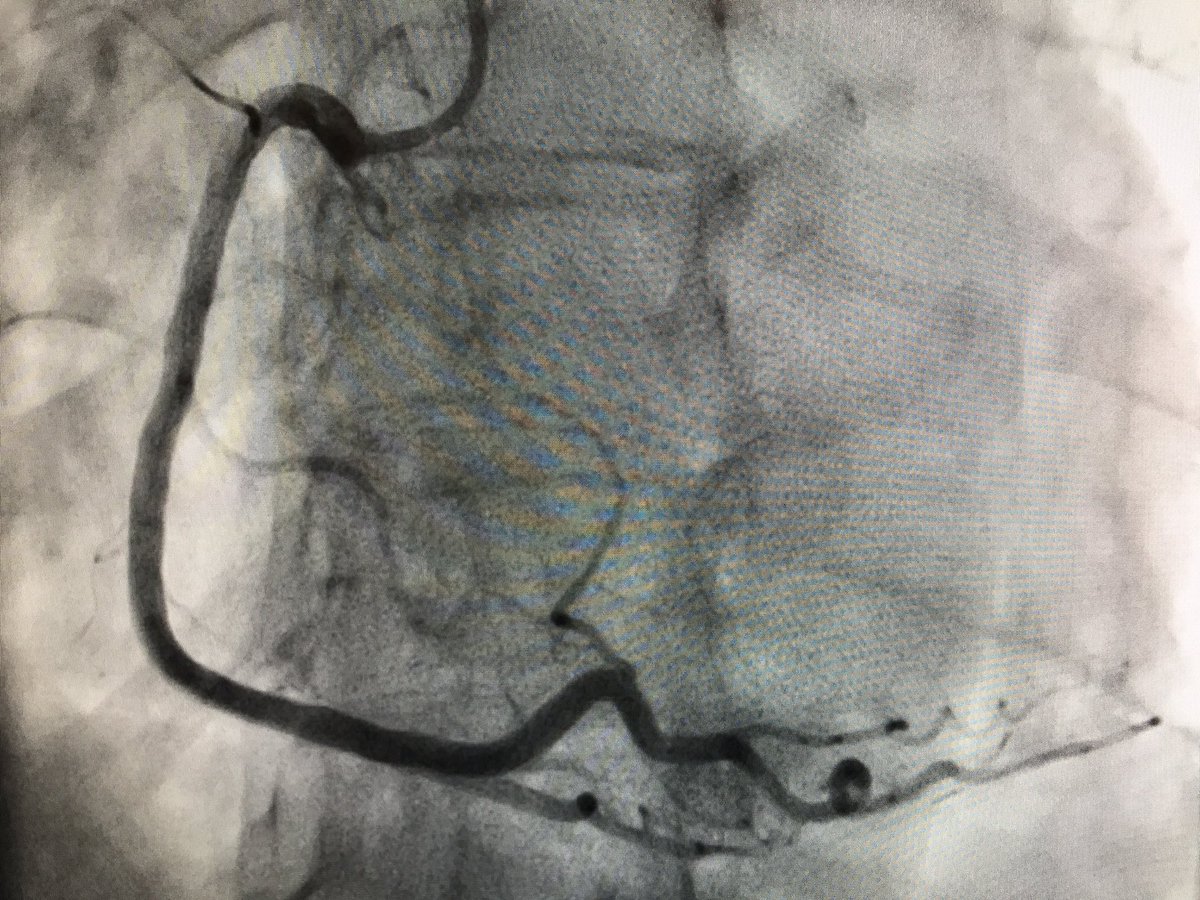 Rahul2282Sharma's tweet photo. 86F, "+Nuc stress", had weak B/L rad pulses. U/S'd both rad's->small (~1mm). Ulnars big, so went U/S-guided right #UlnarSecond. No sign of UAO on f/u. @mmamas1973 @Radial_ICG @SVRaoMD @willsuh76 @chadialraies @DrSheilaSahni @Pooh_Velagapudi https://t.co/6hnaLIiifV