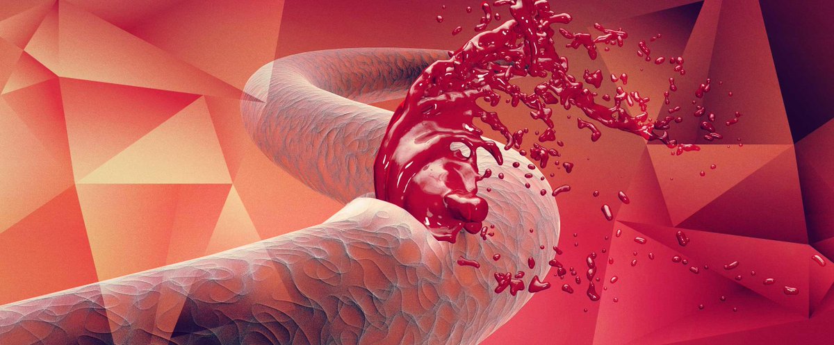 novonordiskfond's tweet photo. 8 ud af 10 dør, når en aorta-aneurisme sprænges. Forskere mener nu, at kunne genskabe blodårernes styrke. #dkforsk https://t.co/EgwdgSYibR https://t.co/aFOVvVfOgE