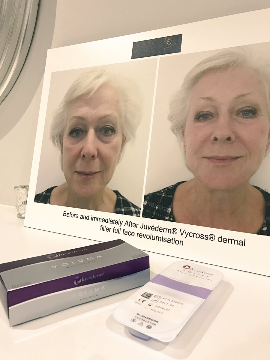 MissBalaratnam's tweet photo. A great mix of treatments in clinic today #consults #VISIA #dermalfillers @SculpSure #DualSculpt @HydraFacialUK @iSCLINICALUK #skincare #ICON #laser @ThreeForMeSkin #ilovemyjob #Beaconsfield #naturalresults https://t.co/UXwXfTUXfi