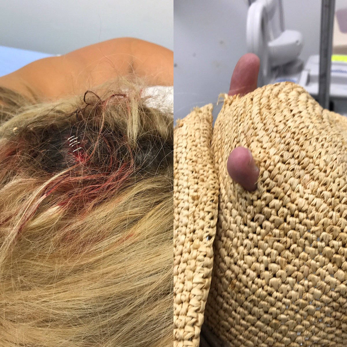 MichelleBayne's tweet photo. Thanks everyone for your sweet messages and concern. My head is on the mend my 💔Grateful for the near miss #route91harvest #PrayForVegas https://t.co/1iYaleCyV2