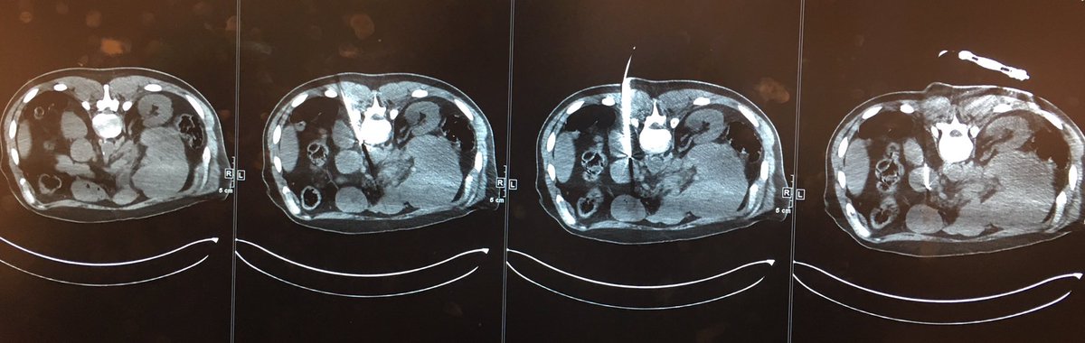 Kidney in the way? No problem - just use an IceForce probe to lever it out of the way, then advance into the tumor.