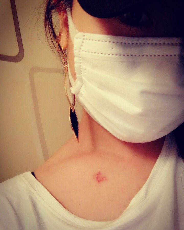 笠井琴美 いやいやいやキスマークみたいやん これは虫刺されです 蚊にキスされました あ じゃーキスマークですね 韓国の蚊に キスマーク付けられました ๑ ㅂ و 笑 痒い 笑 韓国 Korea 蚊に キスマーク 付けられた 人であれ 好きな人