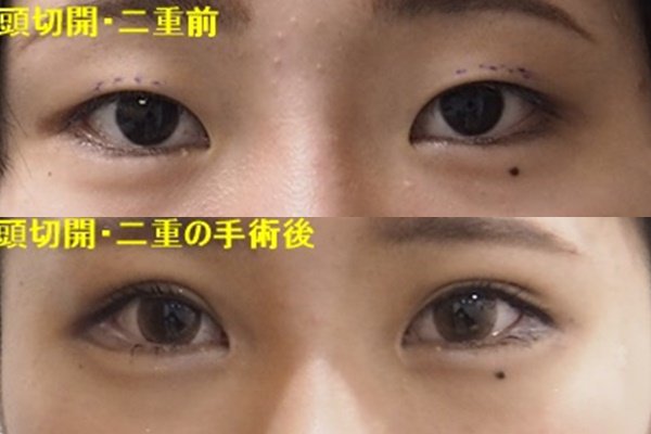 公式 東京形成美容外科 船橋本院 目頭切開 二重の手術を行いました 目頭切開を行い 目の大きさ 目と目の距離が整います 目がぱっちりしましたね Line相談 Line Id Yuge33 東京形成美容外科 0800 080 2784 公式 東京形成美容外科 船橋本院 目頭切開 二重の手術を行いました 目頭切開を行い 目の大きさ 目と目の距離が整います 目がぱっちりしましたね Line相談 Line Id Yuge33 東京形成美容外科 0800 080 2784