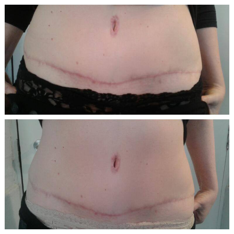 FREE treatment for any scars 9-12 Nov #Nottingham 13 Nov #C-section, #Diep Flap scars only supervised students.  bodyinharmony.org.uk/contact-us