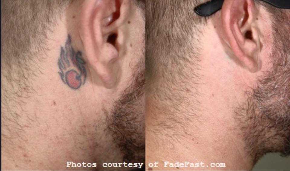 skinmedequip's tweet photo. A lot of people look for treatments that remove #tatoos. We work with Zarin, the best player in the market. https://t.co/79f1IUMGtG https://t.co/DJi99sqiZt