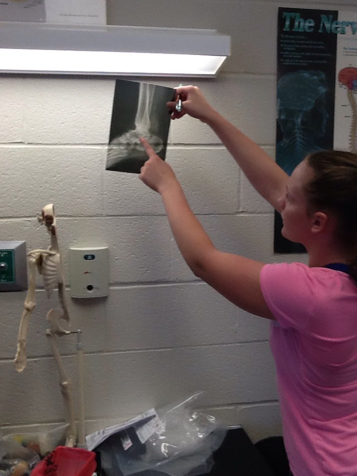 aartisangwan4's tweet photo. Biomed girls dissecting bone to understand the anatomy and then analyzing X-rays to identify fractures. #completelearning @WorcesterTHS https://t.co/vHkot8onUC