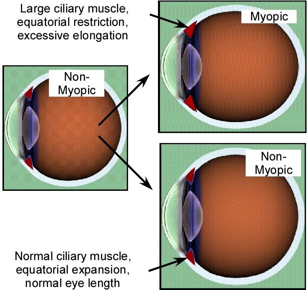 OphthTimes's tweet photo. #Myopia: A close look at efforts to turn back a growing problem | National Eye Institute https://t.co/hqXmPpYHDL #Ophthalmology https://t.co/80A0RdtZQt